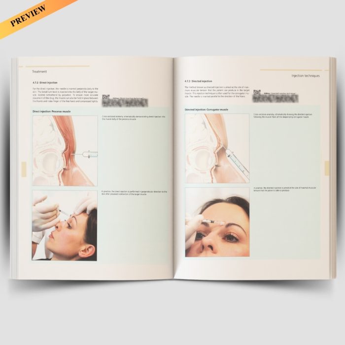 Illustrated Guide to Aesthetic Botulinum Toxin Injections: Basics / Localization / Uses (Aesthetic Methods for Skin Rejuvenation) - Image 4