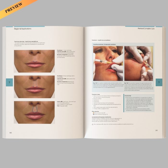 Illustrated Guide to Injectable Fillers: Basics, Indications, Uses – (High quality scanned version) - Image 6